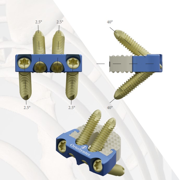 Кейдж шийного відділу хребта блокуючий ALIF (титан-PEEK) - ORTOSYNTEZ